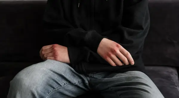 Dłonie z otarciami, siedząca osoba w bluzie i jeansach. To mogą być niebieska karta konsekwencje.